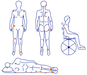 points de pressions escarre 